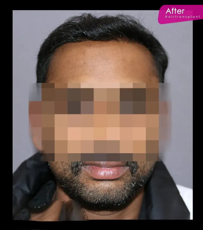 After Hair Treatment