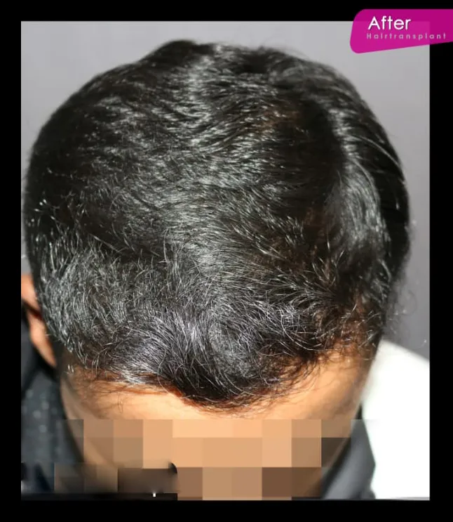 After Hair Treatment