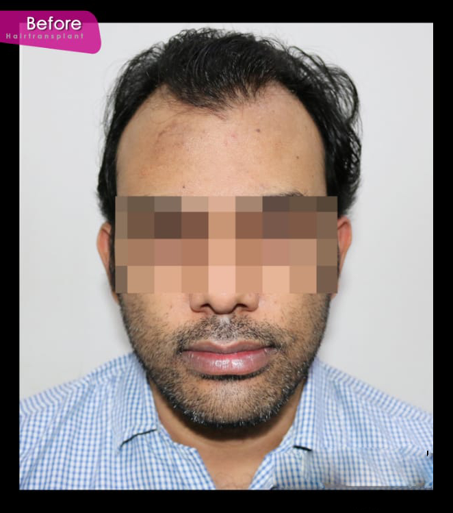 Before Hair Treatment