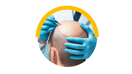 Hair Transplant