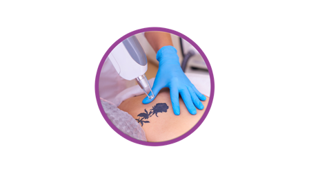 Laser Tattoo Removal